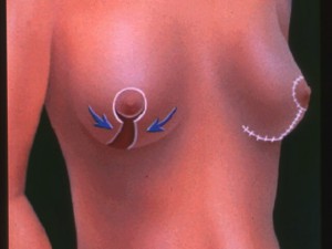 cirugía mamaria